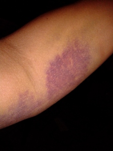Ugly bruises after a nurse took my blood. Thank goodness it was covered by Medi-Cal. 